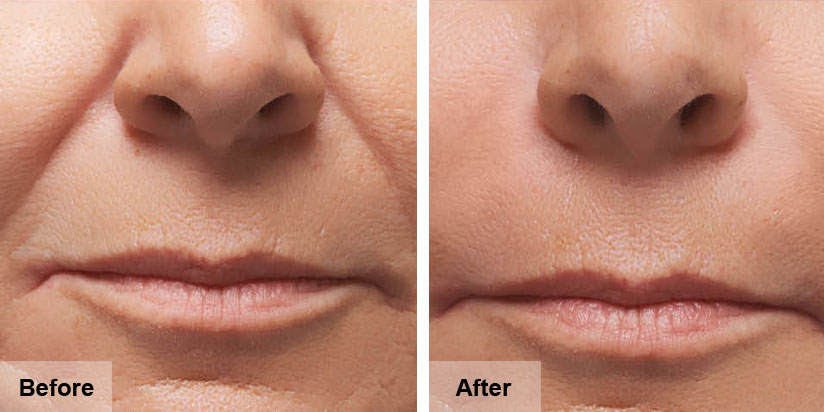 Dermal Fillers