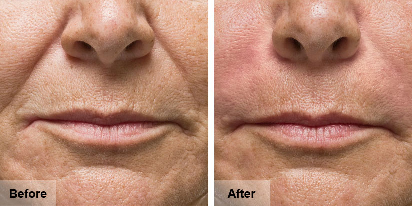 Dermal Fillers