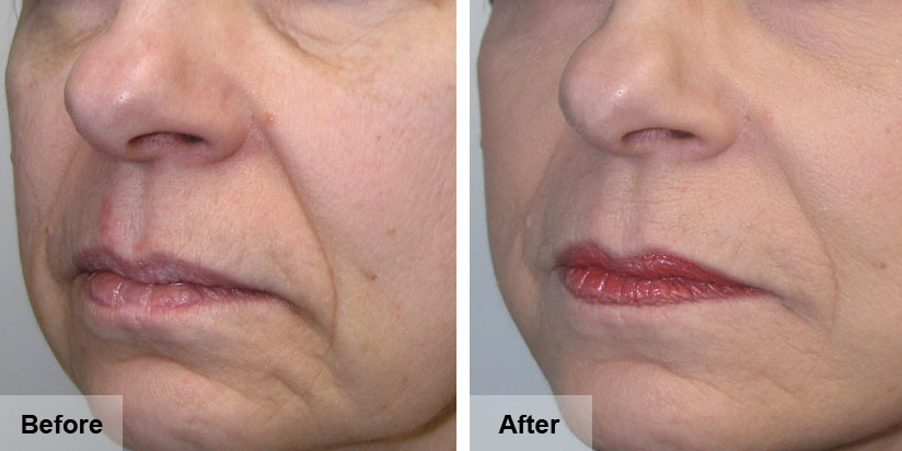 Dermal Fillers